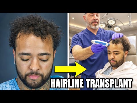 I FINALLY GOT A HAIRLINE TRANSPLANT! 🔥*CRAZY TRANSFORMATION*