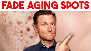 Age Spots Are NOT Normal Aging