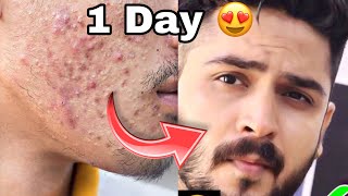 How to remove pimple in 1 Day #shorts #hunkharsh #pimple #acne