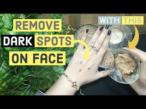 How To Remove "Dark Spots" Caused By Pimples (Cure Black Dots On Face) 2019 Video