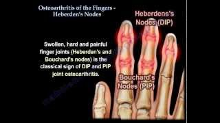 Osteoarthritis Of The Fingers, Heberden