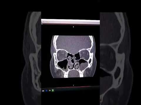 Przewlekłe zapalenie zatok oraz polipy zatok