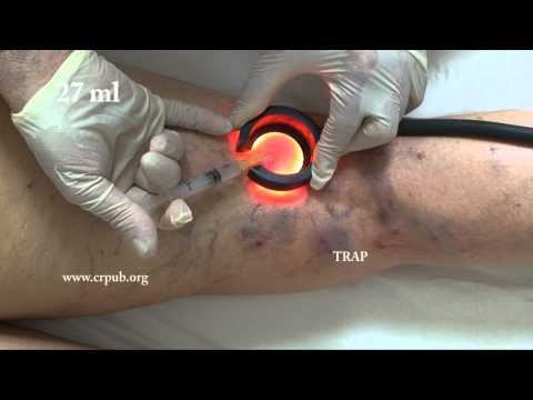 comment guerir une thrombose veineuse