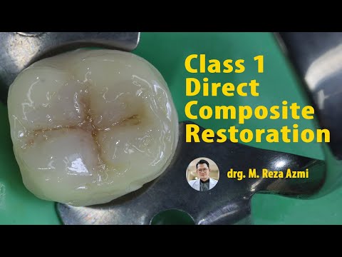 Class I Direct Composite Restoration