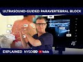 ULTRASOUND GUIDED PARAVERTEBRAL BLOCK