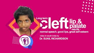 preview picture of video 'Long term cleft lip and cleft palate results - normal speech, good lips, great self esteem'
