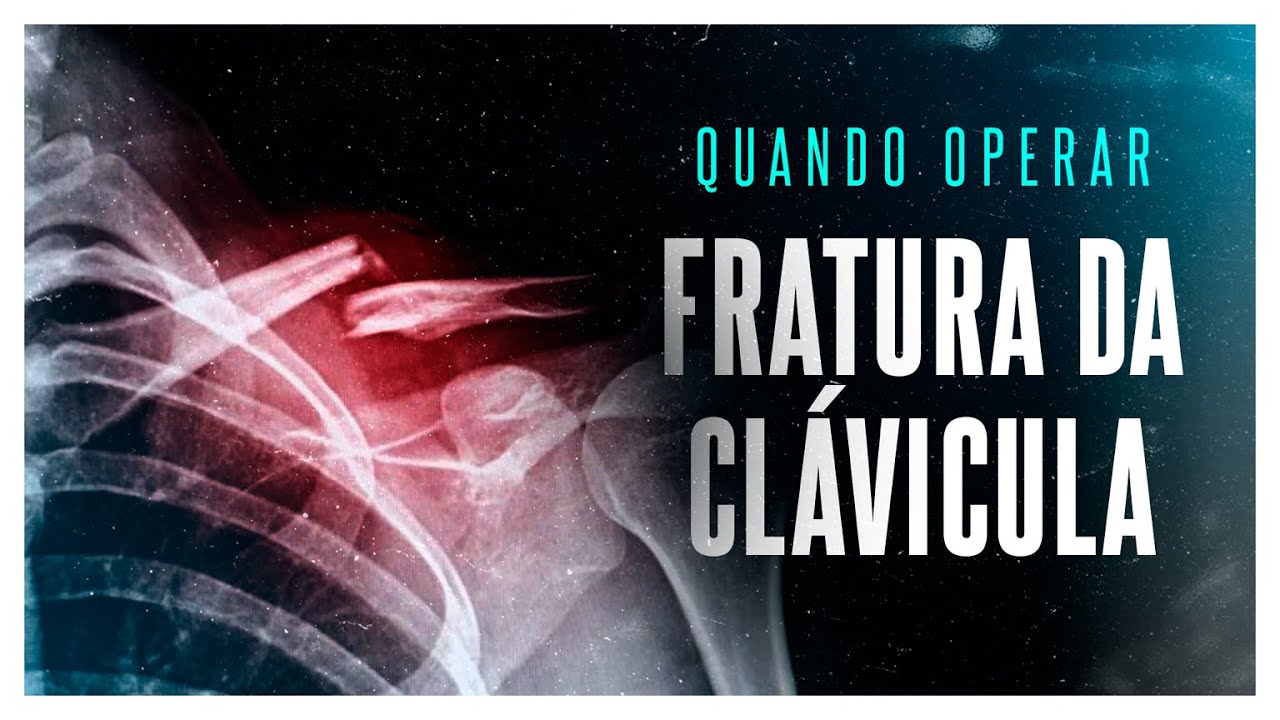 VOCÊ SABE QUANDO DEVE OPERAR A FRATURA DE CLÁVICULA?