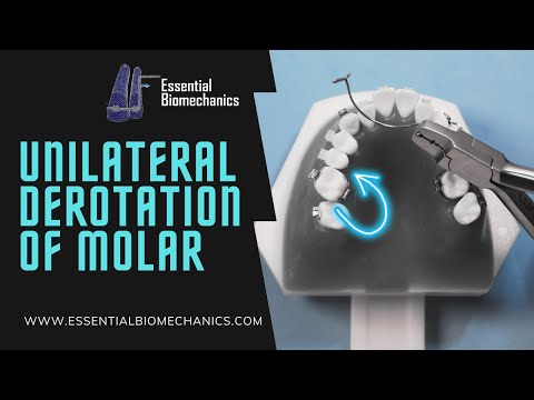 Unilateral derotation of molar with TPA | Essential Biomechanics