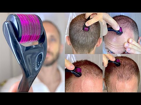 Como Usar o DermaRoller com Minoxidil Aloxidil Tratamento de Calvice Hereditária Queda de Cabelo 4K