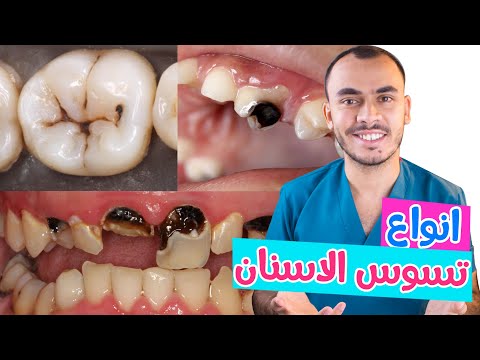 , title : 'انواع تسوس الاسنان اعرف انت اى نوع فيهم ؟'
