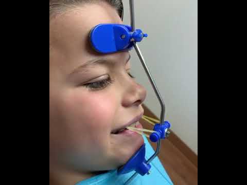 Underbite- gone! Class III orthopedics 👉🏼 3 months 𝐎𝐍𝐋𝐘!