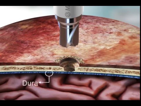 EasyDrill Cranial Perforator