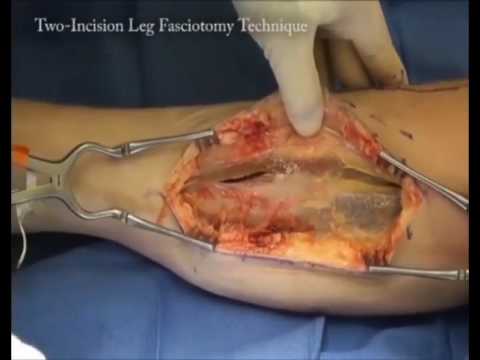 Single and Dual Incision Fasciotomy of the Lower Leg