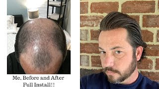 Me, Before and After Full Removal Of A Thin Skin Poly Hair Replacement or Hair System