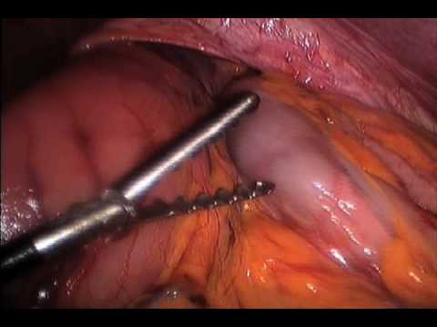 Hiatal Hernia Laparoscopic Correction After Esophagus Excision