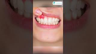 Download lagu చిగుళ్ళపై చీము, వాపు లాంటి లక్షణాలు ఉన్నాయా || Dental Abscess in Telugu || Expert Dental Care mp3