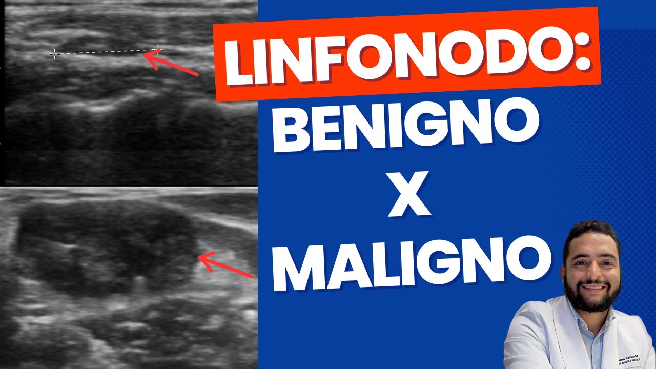 Linfonodo benigno X maligno