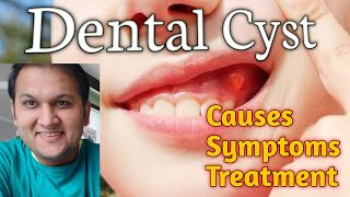 Dental Cyst and Infection: Causes, Symptoms, Types and Treatment