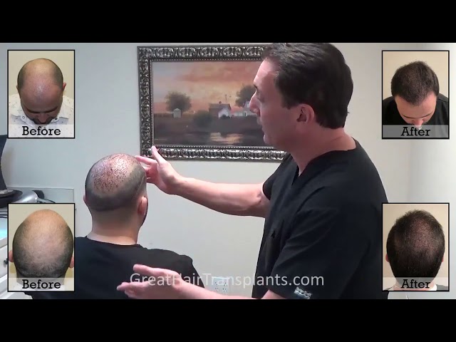 Dr. Brett Bolton Patient Adrien MaxHarvest&trade; Plus - 3 Days Follow up
