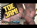 Trimming Fungal Toenails, Corns, Calluses, and Toe Jam: Problems of an At Risk Diabetic
