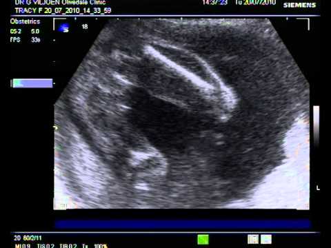 Bump Scan 20 July 2010