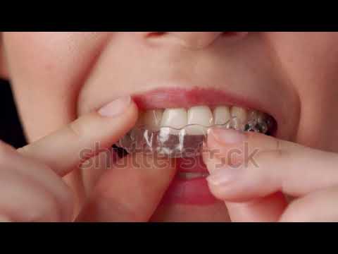 Odontología en Lujan de Cuyo Calle Modesto lima 370 Férula post Ortodoncia
