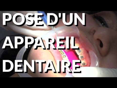 comment appliquer la cire orthodontique