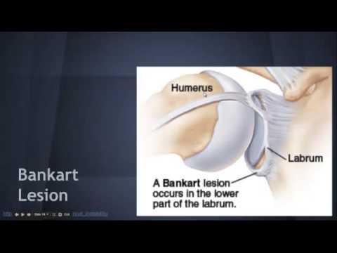 Shoulder Dislocation: Associated injuries -   EM in 5