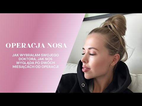 Nose surgery: how I chose my doctor, what my nose looks like two months after the surgery.