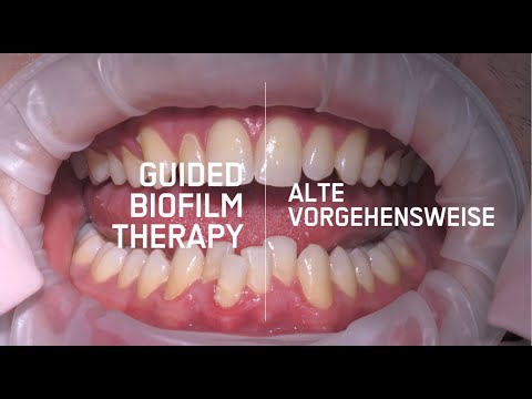 GUIDED BIOFILM THERAPY VS. ALTE VORGEHENSWEISE