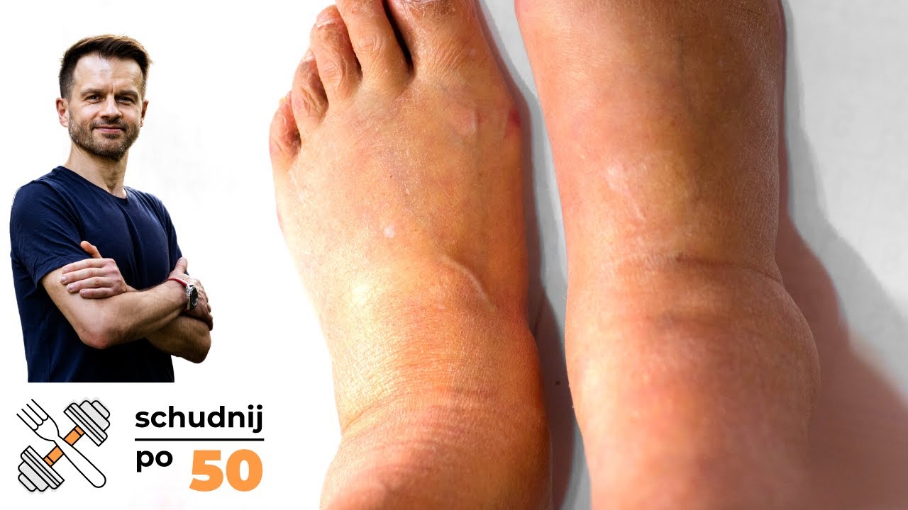 Woda, LIMFA i obrzęki. Dieta na OPUCHNIĘTE NOGI