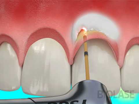 Dental Treatment - Osseous Crown Lengthening with Waterlase Laser Dentistry