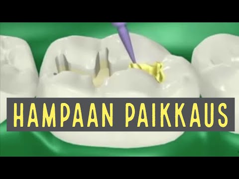 Hampaan Paikkaus ja sen vaiheet. Hammaslääkäri kertoo