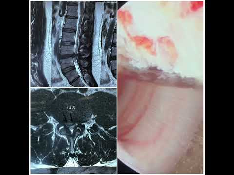 Endoscopic spine surgery - Dr. ajay Kothari