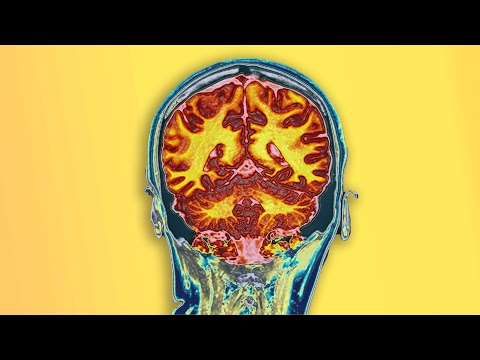 A Student Drank 2 Bottles Dextromethorphan. This Is What Happened To Her Brain.