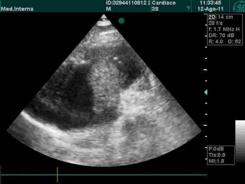 Trombosis en aurícula derecha en ecocardiografía Doppler