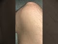 Leg muscle twitch