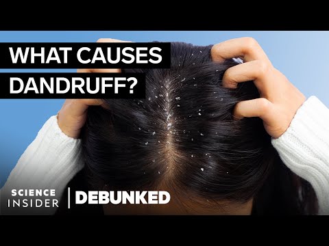Experts Reveal What Really Causes Dandruff And Debunk Other Big Hair Myths