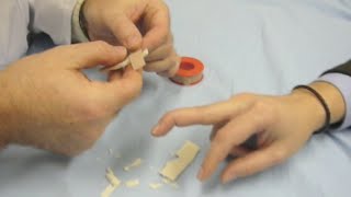 Dedo martillo.  Mallet Finger