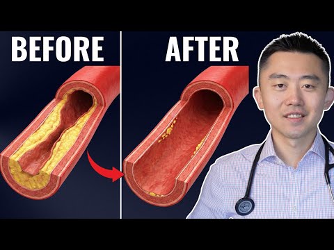 The Best Meal Designed to Clean Your Arteries
