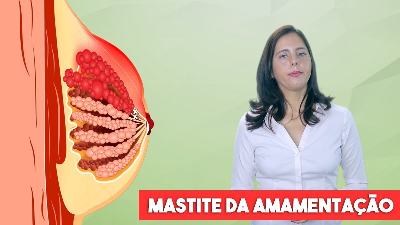 Watch Now Mastite durante a amamentação (mastite lactacional) Mastite durante a amamentação (mastite lactacional)