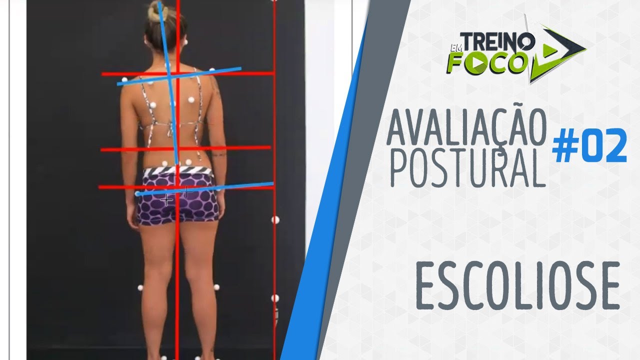 Desvio Postural de Coluna - Escoliose - Avaliação Postural #02