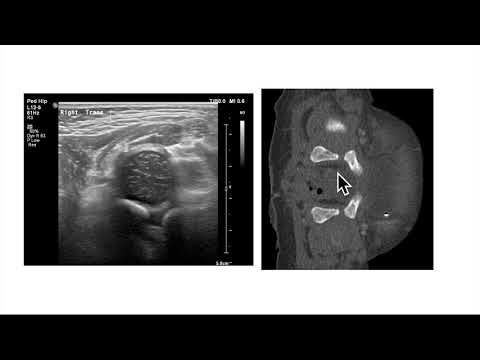 Normal Hip US Part 1