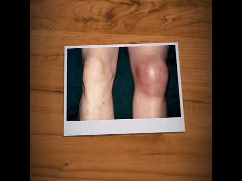 Gél osteochondrosis esetén