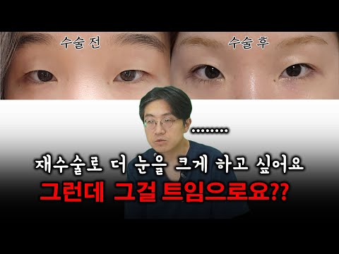 开眼角 01