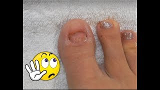No TOENAILS / Make Some / Acrylic  Glitter Toesnails | Using Dual Forms