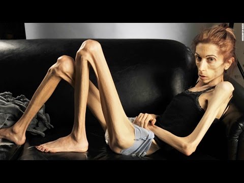 Ulasan resep jintan pelangsing dan berapa banyak melepas Kubis dalam oven untuk menurunkan berat badan