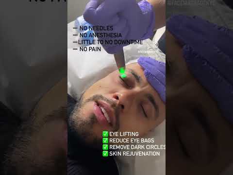 Get Rid of Under Eye Bags and Dark Circles | Fotona Eye Laser for Men | SmoothEye