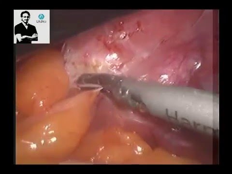 Lyashkov upang mawala ang timbang sa abdomen at isang linggo 7 kg MCC para sa pagbaba ng timbang mga review at larawan