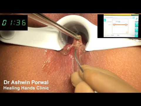 Laser Sphincterolysis in Anal Fissure with Skin Tag | Cure for Anal Fissure | Dr Ashwin Porwal